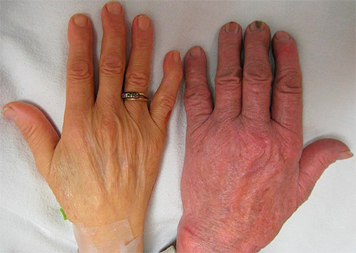 рука человека, страдающего анемией
